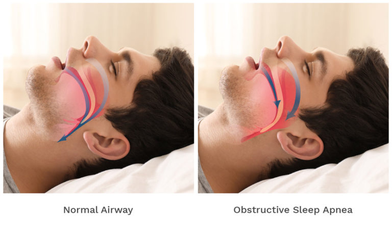 Sleep apnea airway diagram | Real model | Pristine Sleep Services