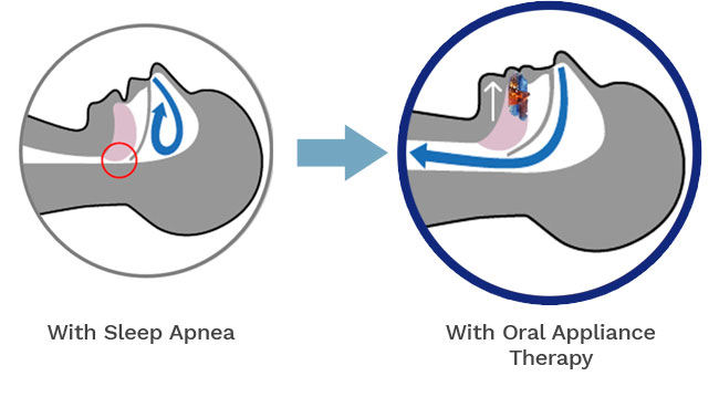 Sleep apnea airway diagram | Pristine Sleep Services